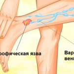 Лечение трофической язвы: советы специалистов для быстрого восстановления